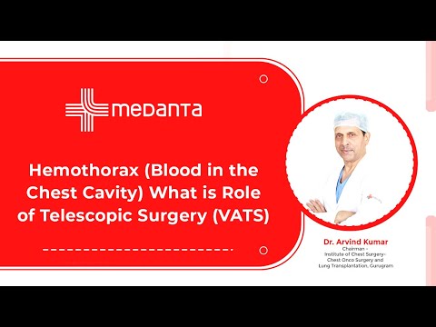  Hemothorax(Blood in the Chest Cavity): What is Role of Telescopic Surgery (VATS)? 